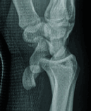 Figure 2 X-ray Sagittal view.