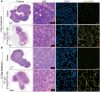 Figure 4. Histology and immunofluorescence imaging showing DNA damage after [225Ac]DOTA-YS5 treatment. H&E and phosphorylated γ-H2AX (p-γ.H2AX) staining confirms morphologic changes and p-γ.H2AX foci for [225Ac]DOTA-YS5 treatment for 7 days (A) and 14 days (B; n = 2).