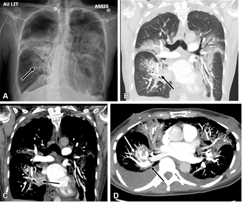 (A) Chest radiograph and (B–D) corresponding reconstructed CT pulmonary angiography images in coronal (B, lung window; C, mediastinal window) and axial (D, maximum intensity projection) views 1 week following admission in a 60-year-old female patient demonstrate deterioration with torsion of the medial basal segment (black arrows) of the right lower lobe. Note the presence of the antler sign (white arrow). (Reprinted, with permission, from reference 27.)