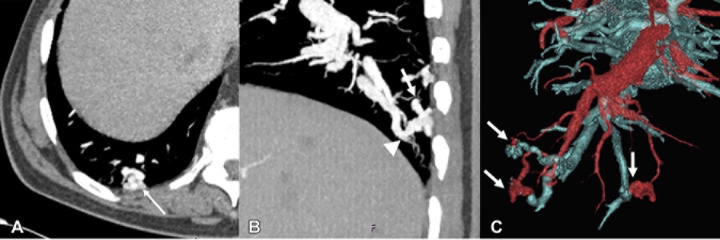 Images in a 76-year-old-male patient with hereditary hemorrhagic telangiectasia and multiple pulmonary arteriovenous malformations. (A) Axial contrast-enhanced CT scan shows a tangle of vessels (arrow). (B) Sagittal contrast-enhanced chest CT scan shows a tangle of vessels with a feeding artery (arrow) and a draining vein (arrowhead). (C) Three-dimensional volume-rendered reconstruction demonstrates multiple pulmonary arteriovenous malformations (arrows), with arteries depicted in red and veins in blue. (Reprinted, with permission, from reference 26.)