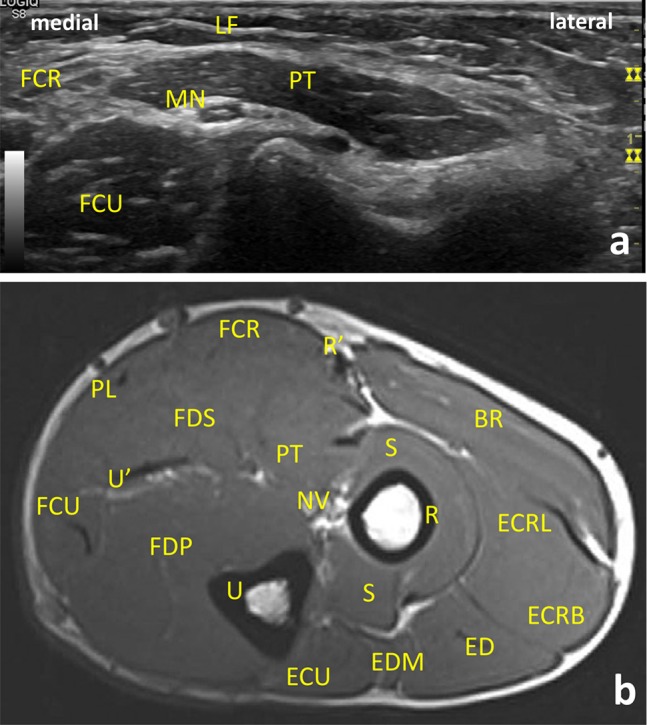 Sonoanatomy of anterior forearm muscles - PMC