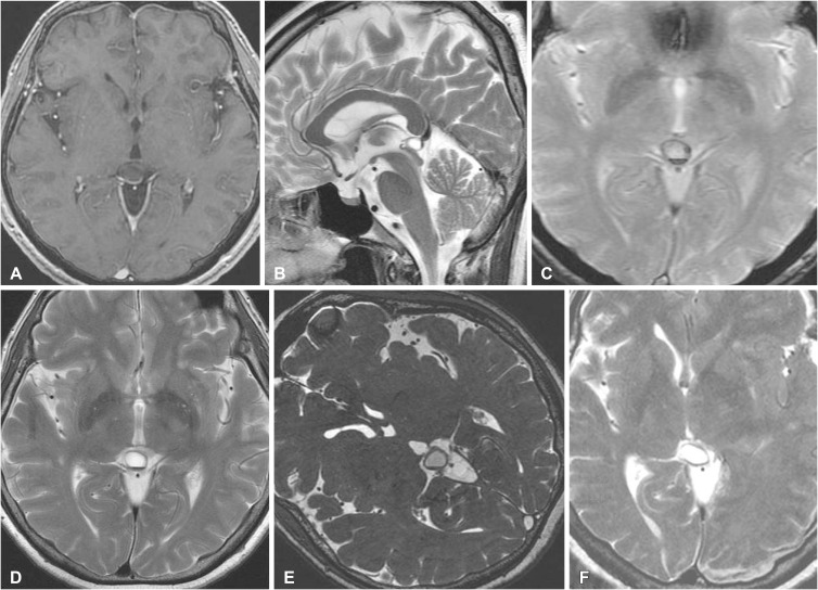 Pineal Cyst Apoplexy: A Rare Complication of Common Entity - PMC