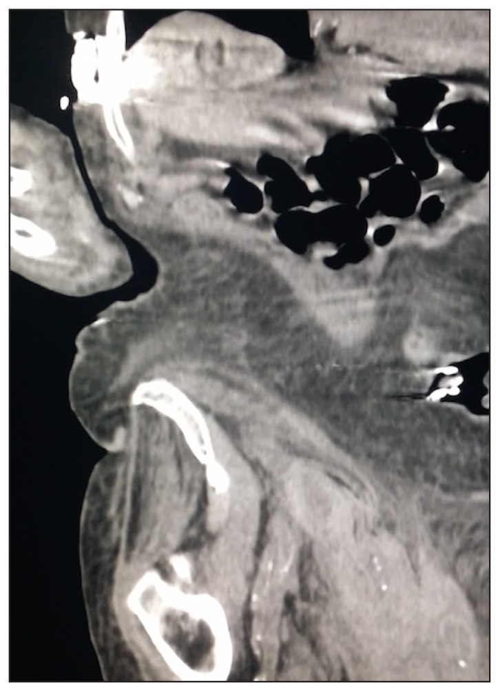 Image Diagnosis: Rapidly Enlarging Scrotal Hematoma: A Complication of ...