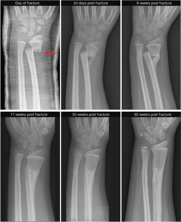 A series of x-ray images displaying a progressively-healing fracture in a child’s wrist.