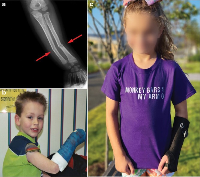 (a) An x-ray of a child’s broken arm, showing two fractures in close proximity to one other. (b) A child sitting on a table in a doctor’s waiting room with a cast on his right forearm. (c) A child standing in a neighborhood park with a soft splint on her left arm and wearing a shirt that reads: “Monkey Bars:1, My Arm: 0”.