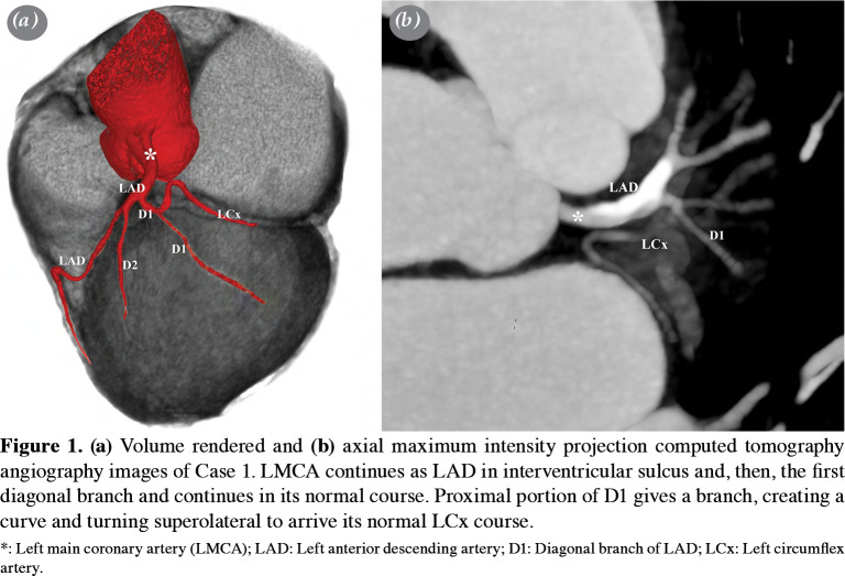 Left Circumflex Coronary Artery Originating From Left Anterior