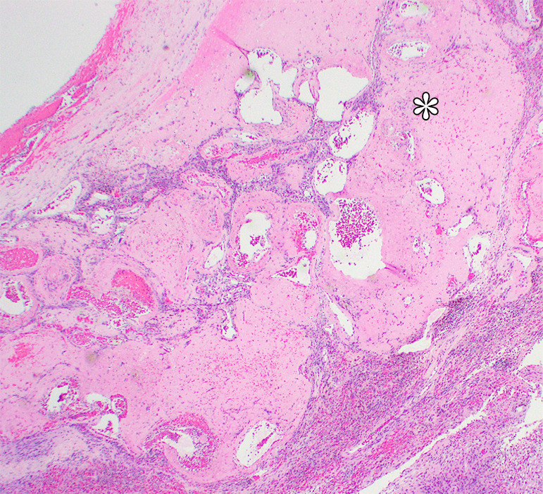 Photomicrographs show (a) cellular mass with cystic changes, hemorrhage, and hyalinized fibrin (*); (b) Antoni A area with bundles of palely eosinophilic spindle Schwannian cells with vague palisading; (c) Antoni B area with loosely arranged Schwannian cells in a myxoid stroma containing inflammatory cells; and (d) diffuse S100 positivity in Schwannian cells. (Hematoxylin-eosin stain, lower power magnification in a, high power magnification in b-d.)