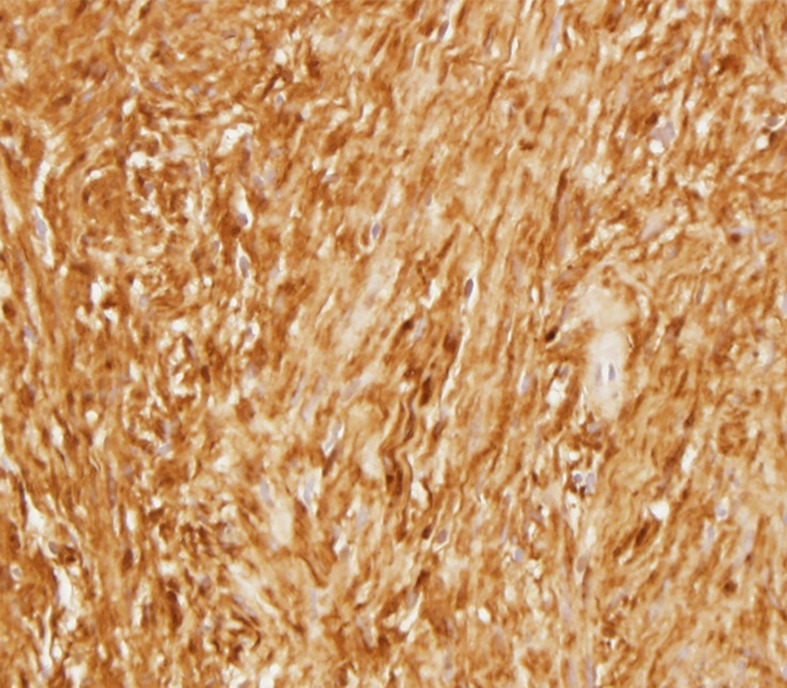 Photomicrographs show (a) cellular mass with cystic changes, hemorrhage, and hyalinized fibrin (*); (b) Antoni A area with bundles of palely eosinophilic spindle Schwannian cells with vague palisading; (c) Antoni B area with loosely arranged Schwannian cells in a myxoid stroma containing inflammatory cells; and (d) diffuse S100 positivity in Schwannian cells. (Hematoxylin-eosin stain, lower power magnification in a, high power magnification in b-d.)