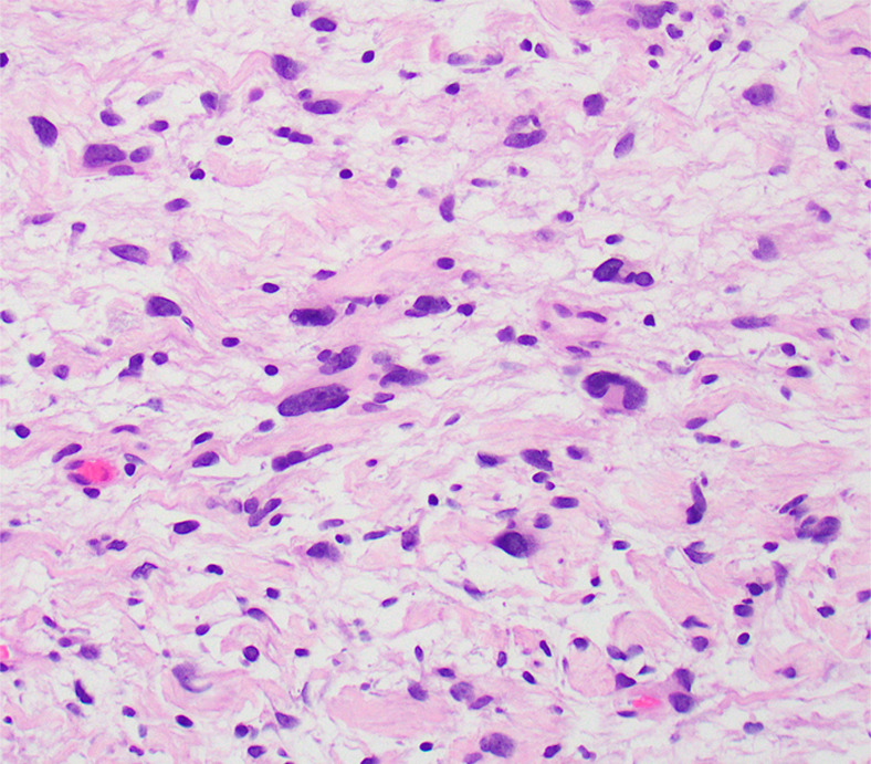 Photomicrographs show (a) cellular mass with cystic changes, hemorrhage, and hyalinized fibrin (*); (b) Antoni A area with bundles of palely eosinophilic spindle Schwannian cells with vague palisading; (c) Antoni B area with loosely arranged Schwannian cells in a myxoid stroma containing inflammatory cells; and (d) diffuse S100 positivity in Schwannian cells. (Hematoxylin-eosin stain, lower power magnification in a, high power magnification in b-d.)