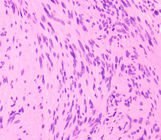 Photomicrographs show (a) cellular mass with cystic changes, hemorrhage, and hyalinized fibrin (*); (b) Antoni A area with bundles of palely eosinophilic spindle Schwannian cells with vague palisading; (c) Antoni B area with loosely arranged Schwannian cells in a myxoid stroma containing inflammatory cells; and (d) diffuse S100 positivity in Schwannian cells. (Hematoxylin-eosin stain, lower power magnification in a, high power magnification in b-d.)