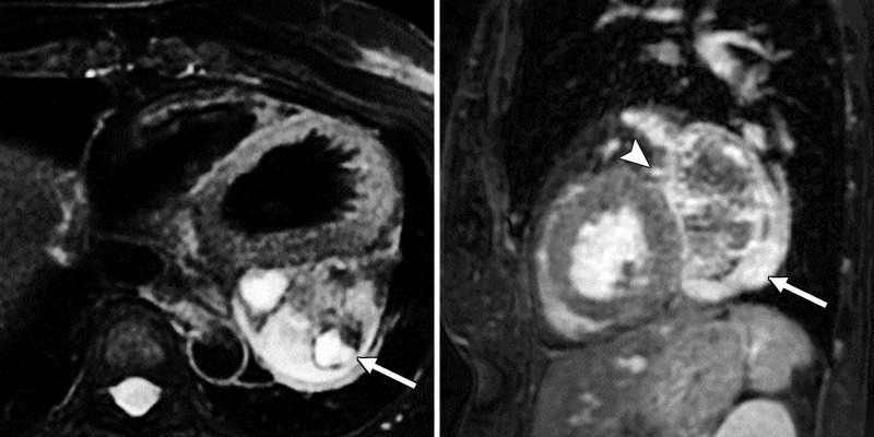 (a) Cardiac T2-weighted double inversion-recovery fat saturation (left) and sagittal three-dimensional heart fat saturation fast gradient-recalled echo sequence (right) MR images show a well-circumscribed, heterogenous, predominantly T2-hyperintense mass adjacent to the left atrium and ventricle (arrow). The arrowhead points to the left circumflex artery coursing along the mass. A 1.2-cm enhancing nodule within the pericardium or epicardial fat was noted along the inferior wall of the left ventricle, likely a lymph node. (b) Cardiac T1-weighted pre- (left) and postcontrast (right) MR images show heterogeneous enhancement (arrows).