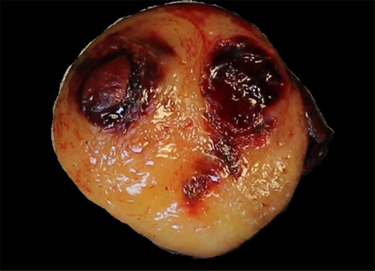 Images of resected schwannoma. (a) Left atrioventricular groove cardiac mass with intact capsule on the lateral surface and (b) thick pseudocapsule on the medial surface extending to approximately two-thirds of the specimen on the lateral side. (c) There is a thin membranous type of pseudocapsule present on the surface of the tumor. The mass appears lobulated and tan-pink to yellow-red in color.