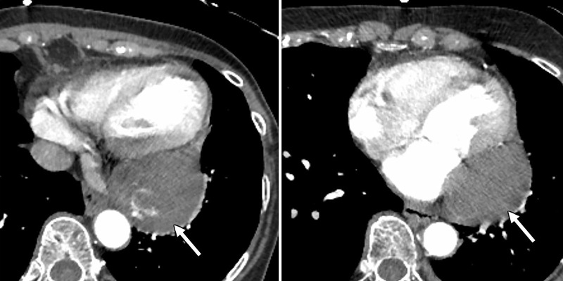 Axial CT angiographic images show a large mass (arrow) associated with the posterior pericardium. Areas of high attenuation represent calcifications. There is mass effect upon the adjacent left atrium and the left ventricle.