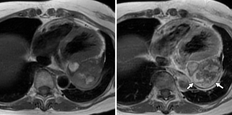 (a) Cardiac T2-weighted double inversion-recovery fat saturation (left) and sagittal three-dimensional heart fat saturation fast gradient-recalled echo sequence (right) MR images show a well-circumscribed, heterogenous, predominantly T2-hyperintense mass adjacent to the left atrium and ventricle (arrow). The arrowhead points to the left circumflex artery coursing along the mass. A 1.2-cm enhancing nodule within the pericardium or epicardial fat was noted along the inferior wall of the left ventricle, likely a lymph node. (b) Cardiac T1-weighted pre- (left) and postcontrast (right) MR images show heterogeneous enhancement (arrows).