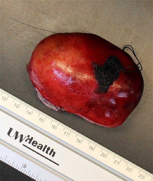 Images of resected schwannoma. (a) Left atrioventricular groove cardiac mass with intact capsule on the lateral surface and (b) thick pseudocapsule on the medial surface extending to approximately two-thirds of the specimen on the lateral side. (c) There is a thin membranous type of pseudocapsule present on the surface of the tumor. The mass appears lobulated and tan-pink to yellow-red in color.