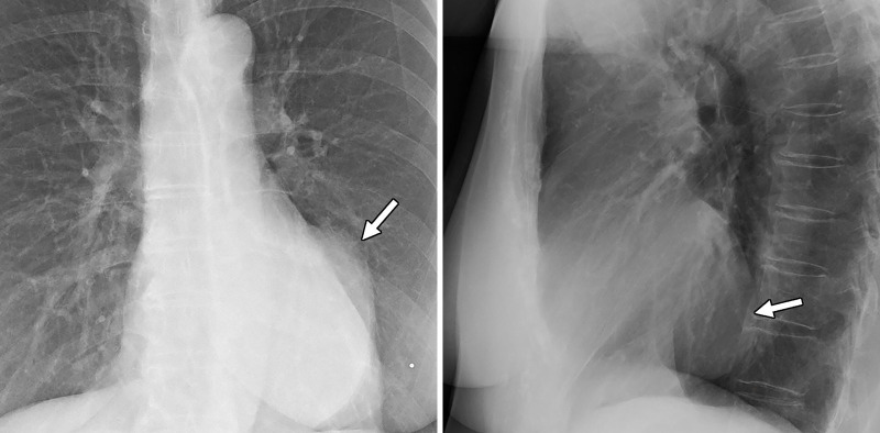 Posterior-anterior and lateral chest radiographs show a large well-circumscribed middle mediastinal mass (arrow).