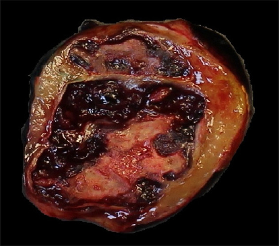 Images of resected schwannoma. (a) Left atrioventricular groove cardiac mass with intact capsule on the lateral surface and (b) thick pseudocapsule on the medial surface extending to approximately two-thirds of the specimen on the lateral side. (c) There is a thin membranous type of pseudocapsule present on the surface of the tumor. The mass appears lobulated and tan-pink to yellow-red in color.