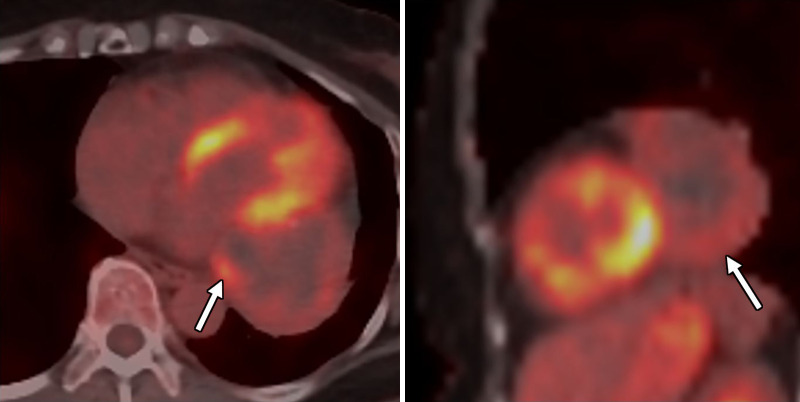 Axial and sagittal fused fluorine 18 fluorodeoxyglucose (18F-FDG) PET/CT images show again a large pericardial mass (arrow) with mild to moderate heterogeneous 18F-FDG avidity (maximum standardized uptake value of 4.8). There are photopenic regions suggestive of cystic changes or necrosis. There were scattered calcifications within that mass at attenuation-correction low-dose CT.