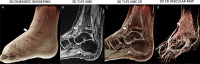 Acute osteomyelitis of the distal tibia in a 5-year-old boy
experiencing lower leg pain. (A) Cinematic three-dimensional (3D) MRI
surface rendering shows a markedly swollen (arrow) ankle and foot. (B)
Sagittal contrast-enhanced 3D T1-weighted fat-suppressed volumetric
interpolated breath-hold examination (T1FS VIBE) and (C) corresponding
cinematic rendering (CR) image demonstrate an intraosseous Brodie-type
abscess (black arrow, B) decompressing into a subperiosteal abscess (white
arrows). (D) The corresponding cinematic rendering vascular map shows marked
hyperemia of the distal tibia (arrow).