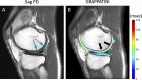 Osteoarthritis in a 49-year-old male patient with chronic left knee
pain. (A) Routine two-dimensional sagittal proton density (Sag PD) MRI scan
demonstrates chondral high signal intensity (blue arrows), and (B) T2 maps
obtained from a sixfold-accelerated GRAPPATINI acquisition (10 echoes,
twofold parallel imaging, threefold acceleration in echo time) demonstrate
mild surface chondral wear over posterior margins of the lateral femoral
condyle with T2 prolongation (black arrows). GRAPPATINI is a combination of
a k-based method for undersampling called generalized autocalibrating
partial parallel acquisition, or GRAPPA, and the reconstruction technique
model-based accelerated relaxometry by iterative nonlinear inversion, or
MARTINI (33).