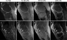 Three-dimensional (3D) ultrashort-echo-time (UTE) MRI scans of the
osteochondral junction in a (A–D) normal cadaveric knee from a
62-year-old male donor and an (E–H) osteoarthritic cadaveric knee from a
87-year-old male donor. (A, E) Two-dimensional T2-weighted (T2) fast spin-echo
(FSE), (B, F) 3D T1-weighted fat-saturated (T1-FS) UTE, (C, G) 3D
inversion-recovery fat-saturated (IR-FS) UTE, and (D, H) 3D dual
inversion-recovery (DIR) UTE images. In the (A–D) normal knee, the
osteochondral junction region was dark on the T2-weighted FSE image due to its
fast signal decay. The normal osteochondral junction regions were highlighted as
bright signal lines in T1-weighted fat-saturated UTE, inversion-recovery
fat-saturated UTE, and dual inversion-recovery UTE images. In the (E–H)
osteoarthritic knee, the osteochondral junction signals were reduced or
completely lost in the abnormal cartilage regions (arrows) of central osteophyte
formation. Of note, there was preservation of overlying cartilage in these
regions. Images courtesy of Yajun Ma, PhD, University of California San
Diego.