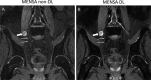 Peripheral nerve-sheath tumor in a 76-year-old male patient with
chronic right leg weakness. Oblique coronal three-dimensional multiecho in
steady-state acquisition (MENSA)/dual-echo steady state MR neurography
images of the lumbosacral plexus reconstructed (A) without and (B) with a
commercially available deep learning (DL) algorithm (AIR Recon DL, GE
Healthcare) demonstrate a peripheral nerve-sheath tumor (thick arrows)
arising from the lower right lumbosacral plexus. Note the increased
sharpness and conspicuity of other nerve branches (eg, obturator nerve [thin
arrows]) and less noise of the surrounding soft tissues in the
Dl-reconstructed image.