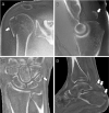 Zero-echo-time MRI scans in four patients after acute trauma. (A) Oblique
coronal image of the glenohumeral joint in a 50-year-old male patient
demonstrates a comminuted greater tuberosity fracture (arrow). (B) Sagittal
image of the left elbow in a 33-year-old male patient demonstrates a superiorly
displaced triceps avulsion fracture (arrow). (C) Coronal wrist image in a
61-year-old male patient shows small capsular triquetral avulsion fracture
(arrow). (D) Sagittal ankle image in a 39-year-old male patient demonstrates
Achilles tendon avulsion fracture off the calcaneus, with retraction of osseous
fragments (arrows). Images courtesy of Ryan Breighner, PhD, Hospital for Special
Surgery.