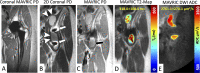 Multiacquisition variable-resonance image combination, or MAVRIC,
three-dimensional techniques for morphologic and quantitative imaging in a
67-year-old female patient with pain after left total hip arthroplasty. (A)
Coronal MAVRIC proton-density (PD) image demonstrates the total hip arthroplasty
in situ. (B) Conventional high-bandwidth coronal proton density image anterior
to the total hip arthroplasty shows signal dropout, pileup, and through-plane
distortion (arrows) within the iliopsoas bursa, which prevents full
visualization of the synovial reaction (arrowheads); these artifacts are
mitigated with (C) a MAVRIC acquisition, which also demonstrates intermediate
signal intensity–dependent debris (presumed metallosis) (black arrow).
(D) MAVRIC T2 mapping and (E) diffusion-weighted imaging (DWI) sequences provide
quantitative T2 and apparent diffusion coefficient (ADC) values, which help to
characterize this abnormal synovial reaction.