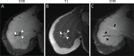 Acute-on-chronic low-grade pectoralis major strain in a 42-year-old male
patient with right chest pain after bench-pressing 1 week before imaging. (A)
Oblique coronal short-tau inversion-recovery (STIR) and (B) T1-weighted MRI
scans demonstrate a small amount of fatty deposition (arrowheads) along the
pectoralis major sternal head myotendinous junction (arrow) compatible with an
old tear. (C) Immediately posterior oblique coronal short-tau inversion-recovery
image demonstrates evidence of more recent, low-grade myotendinous junction
(arrowheads) and intramuscular (arrow) tear.