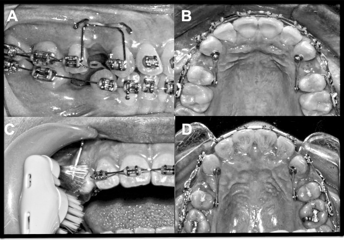 Figure 1. (A, B) Illustration of the mechanics employed for canine distalization; 60 g force was applied to both the control and experimental canines. (C) Application of vibratory stimuli to the canine on the experimental side using an electric toothbrush. (D) Images of the experimental (left) and control (right) sides in a representative case at T3.