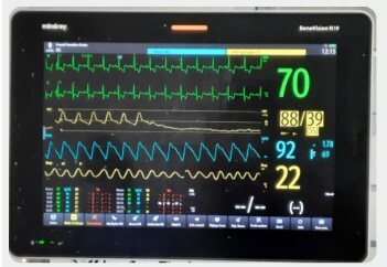 
Figure 2. Wedge PAOP indicating catheter positioning in the pulmonary
artery
