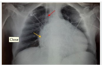 
Figure 3. Chest X-ray imaging showing Swan Ganz introduced through
right jugular vein (red arrow) with distal tip positioned in the right
pulmonary artery (yellow arrow)
