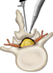 Figure 2. Illustration of PBES laminotomy technique. Taken from Kang et al.65