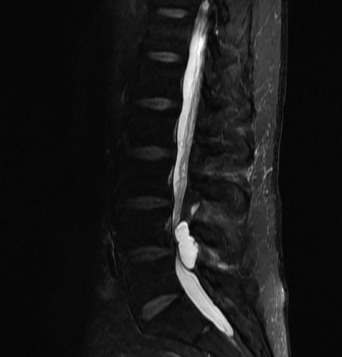 Figure 3. The cystic mass was shown on a sagittal “fat suppression” MRI scan and taken from Roberti et al.67