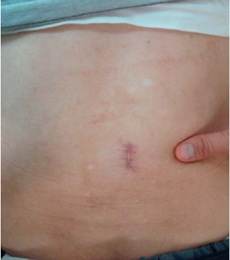 Figure 1. Surgical scar left by minimally invasive surgery. Taken from Sairyo et al.66