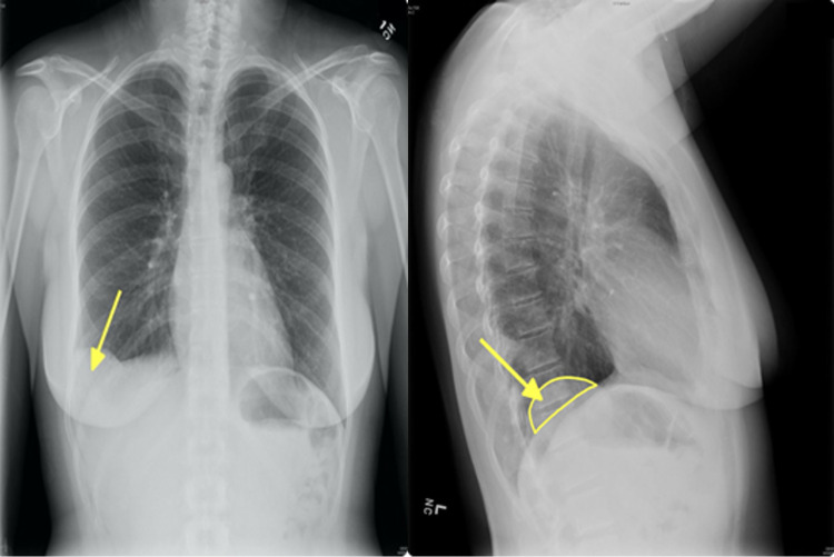 Symptomatic Pulmonary Hamartoma - PMC