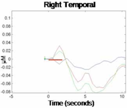 Fig. (2) Hemodynamic Response Function: Right temporal area (T4).