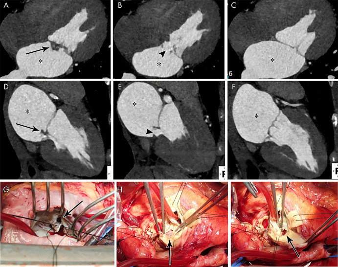 A–C, Four-chamber and, D–F, two-chamber contrast-enhanced CT images in a 39-year-old woman show focal ill-defined attenuation along the inferior aspect of the anterior mitral valve leaflet (vegetation, arrows) associated with leaflet perforation (arrowheads) and left atrial dilatation (*). G, Intraoperative image in a 32-year-old woman with infective endocarditis shows mitral valve leaflet perforation (arrow). H, I, Intraoperative images in a 49-year-old man with infective endocarditis show aortic valve leaflet perforation (arrows).