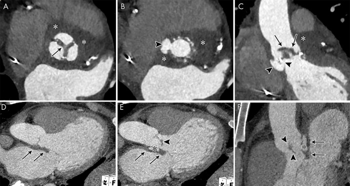 A, B, Short-axis and, C, oblique coronal contrast-enhanced CT images of the aortic valve in an 83-year-old man show bioprosthetic valve leaflet thickening with mobile nodular leaflet hypoattenuation (arrows, Movie 1 [supplement]). There is a large soft-tissue low-attenuation area surrounding the aortic root consistent with a periaortic abscess (*) with left ventricular outflow tract (LVOT) pseudoaneurysm (arrowheads). D, E, Three-chamber and, F, sagittal oblique contrast-enhanced CT images in a 46-year-old man show a nodular attenuation along the valve leaflet with linear attenuation extending into the LVOT (arrowheads), and contrast material–filled pseudoaneurysm (*) arising from the LVOT and extending adjacent to the thickened intervalvular fibrosa and the anterior mitral valve leaflet base (arrows).