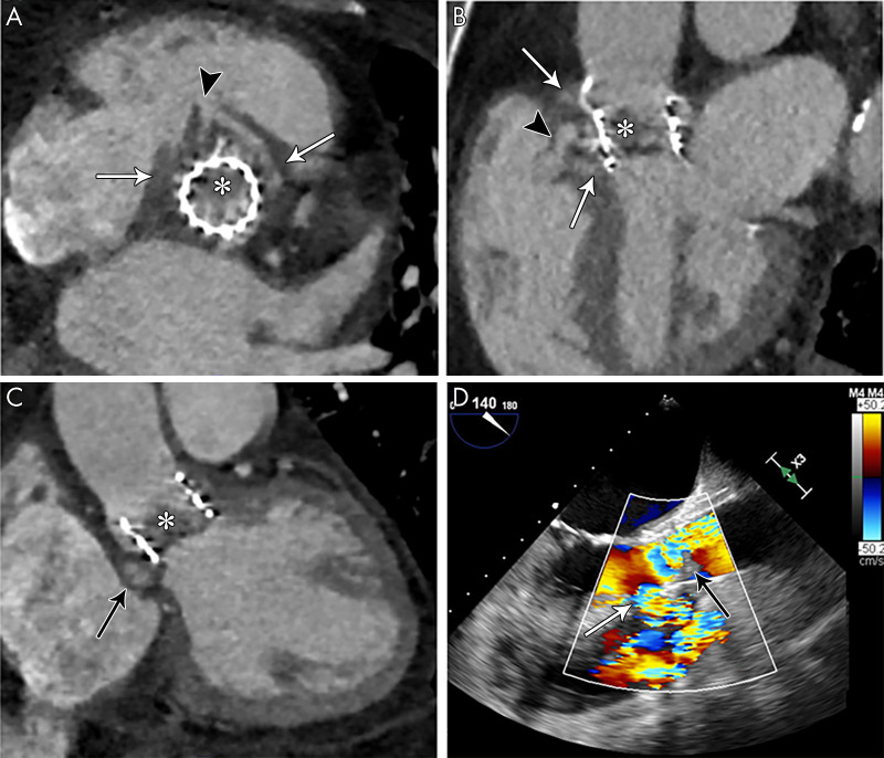 A, Short-axis and, B, C, oblique long-axis contrast-enhanced CT images in a 71-year-old woman show transcatheter aortic valve replacement (TAVR) with a partially obstructing eccentric low-attenuation area compatible with vegetation (*); an adjacent heterogeneous ill-defined low-attenuation area that is partially filled with contrast material (arrows), likely representing abscess and/or pseudoaneurysm; and a contrast material–filled fistula (arrowheads) communicating with the right ventricular outflow tract (RVOT). D, Transesophageal echocardiography color Doppler image in the same patient shows echogenicity partially obstructing TAVR, reflecting vegetation (black arrow), with evidence of flow in the fistulous tract with the RVOT (white arrow, Movie 3 [supplement]).