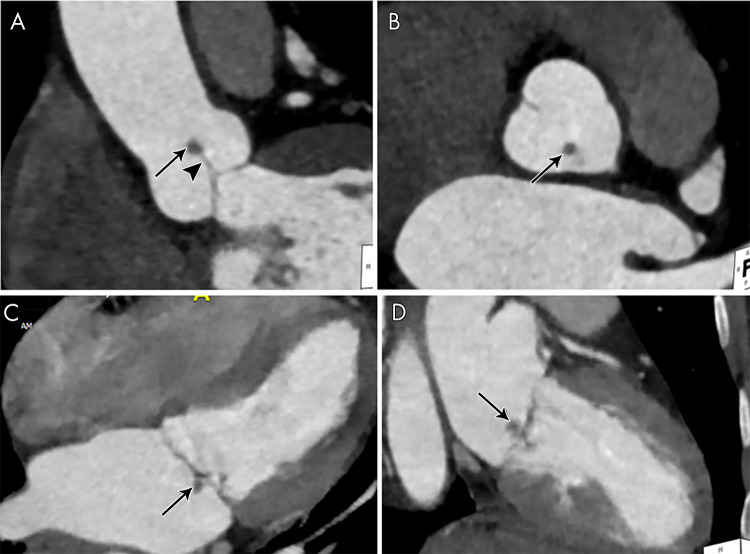 A, B, Contrast-enhanced CT images in an asymptomatic 60-year-old woman show a small (3 × 4 mm) nodular hypoattenuation (arrows) with a thin stalk (arrowhead) attached to the aortic valve cusp. C, D, Four-chamber and two-chamber contrast-enhanced CT images in a 49-year-old woman with no signs of infection show a small (approximately 6 mm) nodular hypoattenuation (arrows) along the mitral valve atrial aspect. Differential diagnosis for these imaging findings includes fibroelastoma and myxoma. Thrombus and vegetation were less favored in this patient with no signs of infection or risk of thrombus formation. Both lesions were resected, and pathologic examination showed fibroelastomas.