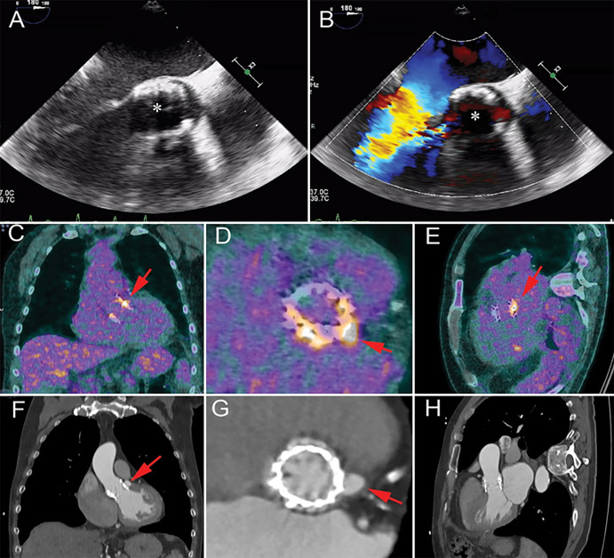 Images show a 62-year-old man with a history of transcatheter aortic valve replacement (TAVR) 6 months prior to presentation with fever and blood cultures positive for Streptococcus pneumonia. A, B, Transesophageal echocardiography images show a TAVR (*) with no signs of endocarditis. C–E, Coronal, valve short-axis, and three-chamber images from fluorine 18 fluorodeoxyglucose (18F-FDG) PET/CT performed 3 days after echocardiography show focal 18F-FDG uptake near the region of the left coronary cusp (arrows). F–H, Contrast-enhanced CT angiography images obtained after 6 weeks (patient was treated with antibiotics) show a pseudoaneurysm (arrows) at the site of aortic annulus in the same 18F-FDG uptake region.