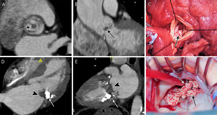 A, Short-axis and, B, oblique coronal contrast-enhanced CT images of the aortic valve in a 59-year-old man with a history of aortic valve replacement who presented with fever and stroke, concerning for infective endocarditis (IE). Images show a nodular attenuation (arrows, approximately 6 mm) along the prosthetic leaflet, suggesting vegetation. C, Intraoperative image in a 34-year-old man shows native aortic valve vegetations (arrow). D, Four-chamber and, E, two-chamber contrast-enhanced CT images in a 72-year-old woman suspected of having IE show severe mitral annular calcification (arrows) and ill-defined hypoattenuation (arrowheads) predominantly along the posterior mitral valve leaflet and the posterior mitral annulus compatible with vegetations. F, Intraoperative image in a 51-year-old man shows native mitral valve vegetations (arrows).