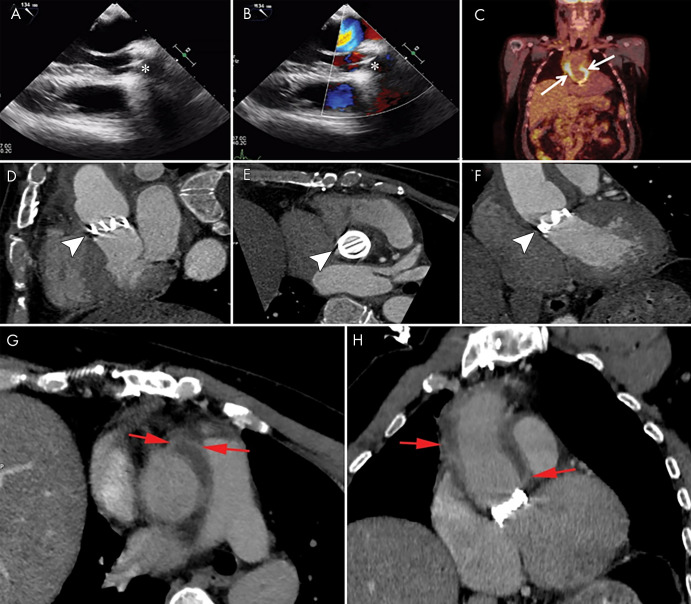 Images show a 48-year-old man with a history of Bentall surgery with placement of a mechanical valve 3 years prior to presentation with fever and positive blood cultures for Staphylococcus aureus. A, B, Transesophageal echocardiography images show a normal appearance of the mechanical valve (*) with no signs of endocarditis. C, Fluorine 18 fluorodeoxyglucose (18F-FDG) PET/CT image shows intense 18F-FDG uptake around the aortic prosthesis (arrows). D–F, Contrast-enhanced CT images show the mechanical valve (arrowheads) and, G, H, fluid collection with enhancing rim surrounding the aortic graft compatible with abscess (red arrows).