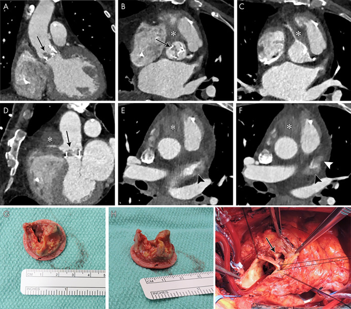 A, Oblique coronal, B, C, short-axis, and, D, oblique sagittal contrast-enhanced CT images through aortic valve and root, and, E, F, axial contrast-enhanced CT images in a 72-year-old man show bioprosthesis leaflet thickening and calcifications with nodular attenuation reflecting vegetation (arrows), ill-defined low-attenuation area (*) anterior to the aortic root and ascending aorta that partially encases the right coronary artery compatible with abscess and phlegmon, and filling defects in the left atrial appendage (arrowheads), suggestive of thrombi (confirmed with transesophageal echocardiography). G, H, Valve vegetations are shown on the excised aortic valve bioprosthesis. I, Intraoperative image shows aortic root abscess cavity (arrow).