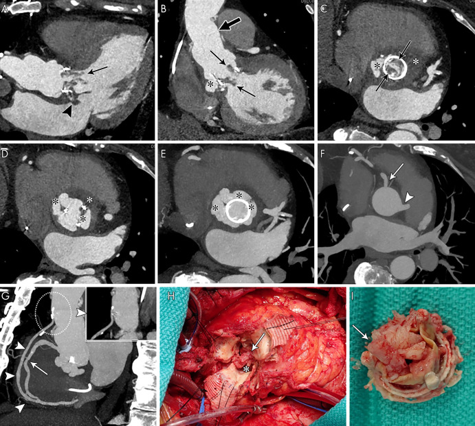 Coronary CT angiography was requested for preoperative evaluation of a perivalvular extension and native coronary arteries and aortocoronary graft in a 67-year-old woman. A, Three-chamber, B, oblique coronal, and, C, D, aortic valve and root short-axis contrast-enhanced CT images show aortic bioprosthesis valve leaflet thickening with nodular and linear hypoattenuation extending into the left ventricular outflow tract (vegetations, arrows) and aortic root pseudoaneurysm (black *) with a low attenuation area suggesting abscess (white *). There is abnormal nodular hypoattenuation with focal contrast material outpouching from the septal aspect of the left atrium near the mitral annulus, likely an extension of the adjacent aortic root abscess (arrowhead, A). Supracoronary graft is noted (thick arrow, B). E, F, Aortic root short-axis maximum intensity projection shows the aortic root pseudoaneurysm (black *) and intact right coronary artery (solid arrow) and left main coronary artery (arrowheads). G, Oblique sagittal maximum intensity projection image shows a widely patent aortocoronary graft from proximal native ascending aorta to distal (arrowheads, dashed circle with magnified thin-section image shows patent graft origin and proximal course) and midright coronary artery stenosis (25%–50% narrowing, arrow). H, I, Intraoperative images show bioprosthetic aortic valve vegetations (arrows) and aortic root pseudoaneurysm and abscess (*).