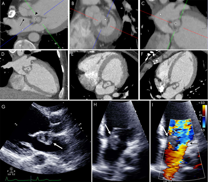 A–F, Contrast-enhanced CT images in a 21-year-old man show mitral valve leaflet thickening extending into the intervalvular fibrosa (arrow, A), anterior mitral valve leaflet elongation, and a contrast material–filled cavity (*) along the atrial side of the anterior leaflet outlined by bilobed low attenuation. The appearance is compatible with valve vegetation with abscess and/or pseudoaneurysm, which appears to communicate with the left ventricular outflow tract (arrowhead, A), giving a windsock appearance. The left ventricle appears dilated. G–I, Echocardiographic images in the same patient show heterogeneous echogenicity attached to the atrial side of the thickened anterior mitral leaflet with central echo poor areas (white arrows) and severe mitral regurgitation (black arrow on color Doppler image, I).