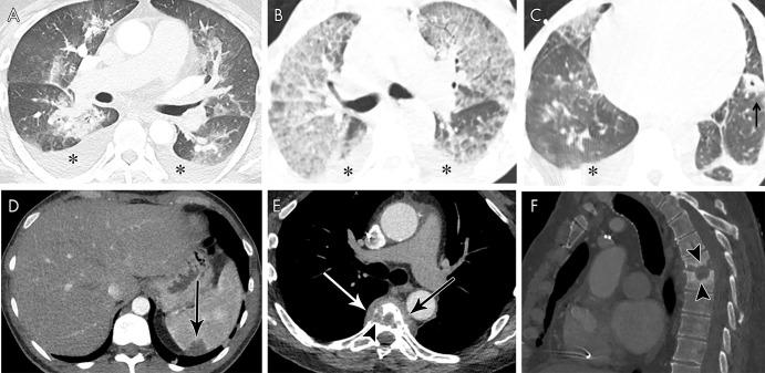 A, Axial contrast-enhanced CT image in a 46-year-old man with mitral and aortic valve infective endocarditis (IE) shows pleural effusions (*) and peribronchial ground-glass and consolidative opacities, suggesting pulmonary edema. B, C, Axial non–contrast-enhanced CT images in a 55-year-old man with multivalvular IE show pleural effusions (*) and upper-zone predominant ground-glass opacities with septal thickening, suggesting pulmonary edema. Left lower lobe cavitating nodule (arrow) represents a septic embolus. D, Axial contrast-enhanced CT image in a 38-year-old man with aortic valve IE shows a splenic peripheral low-attenuation area of infarct (arrow). E, F, Axial (soft-tissue window, E) and sagittal (bone window, F) contrast-enhanced CT images in a 66-year-old man with bioprosthetic aortic valve IE show midthoracic vertebral end-plate destruction and sclerosis (arrowheads) with paravertebral heterogeneous attenuation (arrows) consistent with spondylodiscitis.