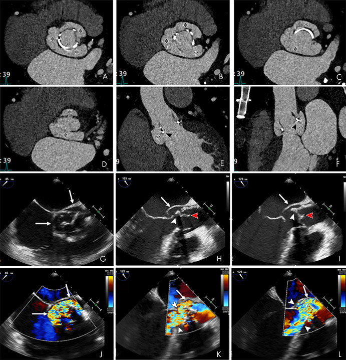 A–D, From top to bottom, short-axis and oblique coronal, as well as, E, F, sagittal contrast-enhanced CT images of the aortic valve and root in a 39-year-old man show a large near-circumferential aortic root contrast agent–filled pseudoaneurysm (*) that communicates freely with the left ventricular outflow tract (LVOT) with malalignment of the bioprosthesis (arrowheads) predominantly along the posterior aspect of the valve, suggesting prosthesis dehiscence. G–I, Transesophageal echocardiography (TEE) images in the same patient show an echo poor area surrounding the posterior aspect of the prosthetic aortic valve (arrows) and communicating with the LVOT with evidence of disinsertion of the prosthetic aortic valve (arrowheads), reflecting dehiscence. Prosthetic valve leaflet thickening is noted (arrowheads). J–L, TEE color Doppler images show flow in the perivalvular echo poor area consistent with pseudoaneurysm (arrows) with perivalvular leak and severe aortic regurgitation (arrowheads, Movies 4 and 5 [supplement]).