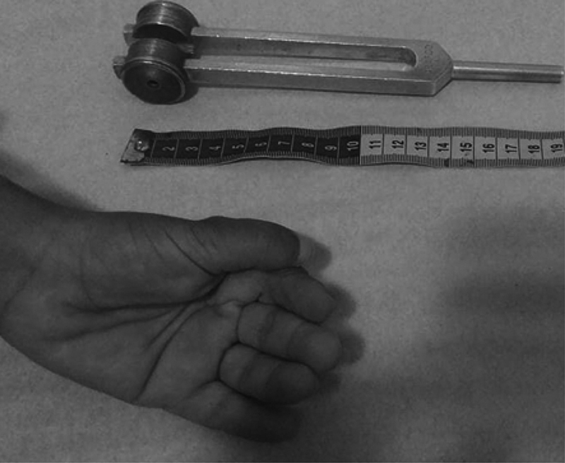 Late onset lennox gastaut syndrome with chromosome 15q duplication in